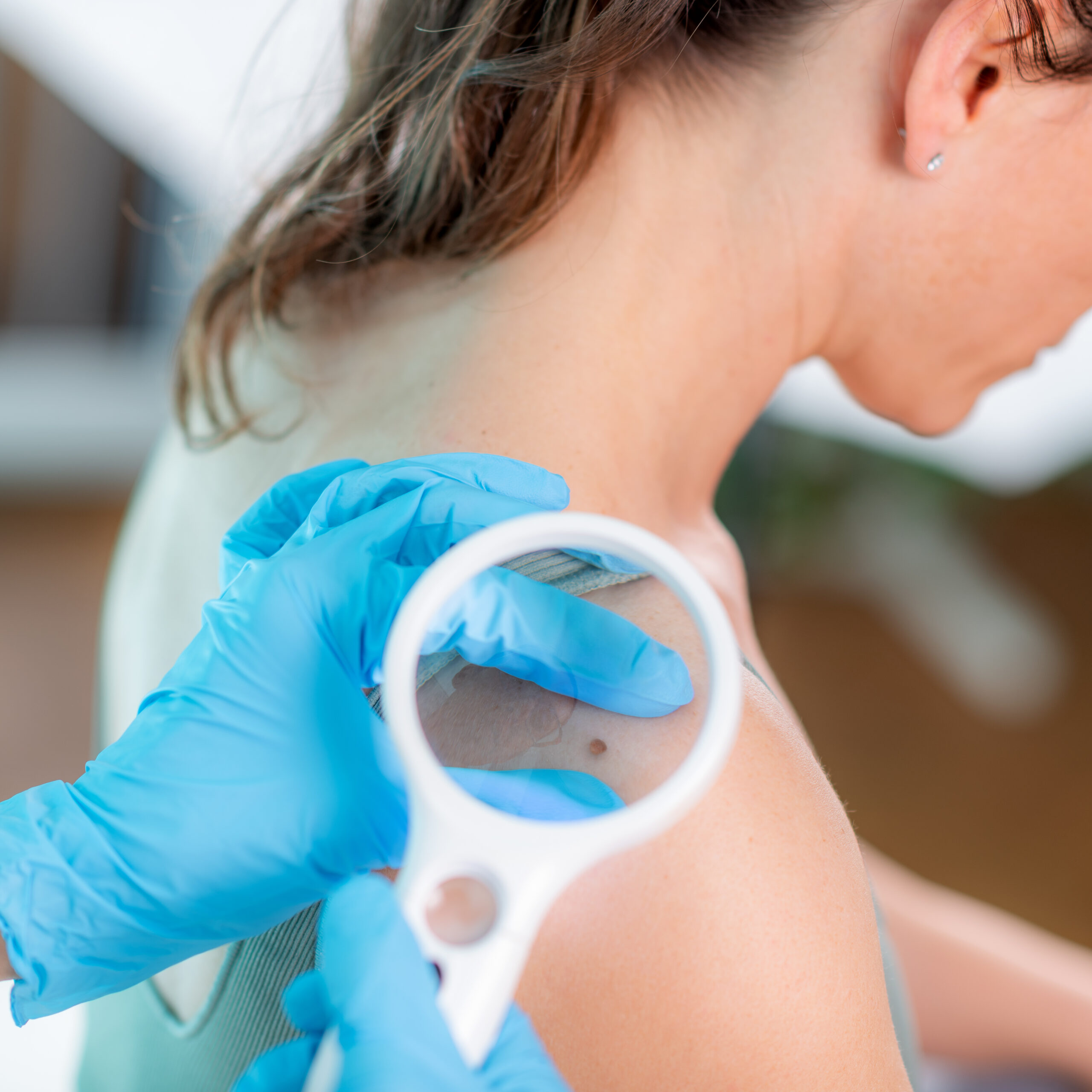 Detecting Skin Moles Under Magnifying Lamp for Cancer Prevention and Early Intervention